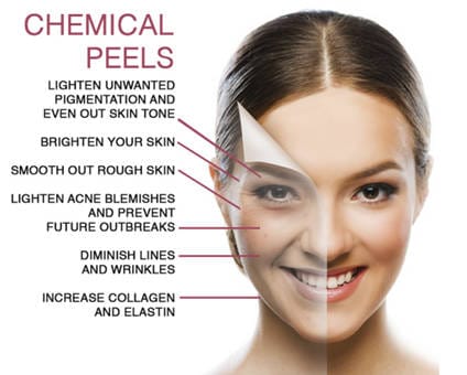 Glycolic Acid peel